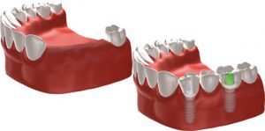 Ersatz mehrerer Zähne im Seitenzahnbereich durch eine implantatgetragene Brücke